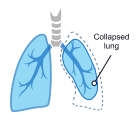 Collapsed Lung Diagram