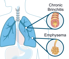 COPD Diagram
