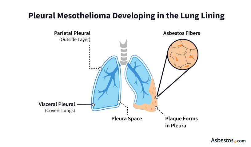 How pleural mesothelioma develops in the lung linings.