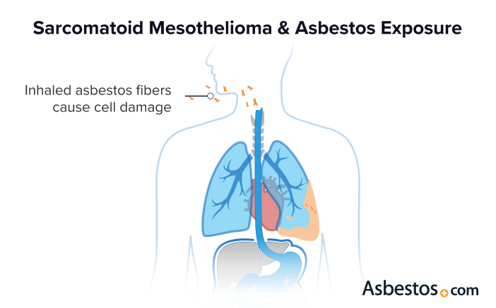 Diagram of how inhaling asbestos fibers can cause sarcomatoid mesothelioma.